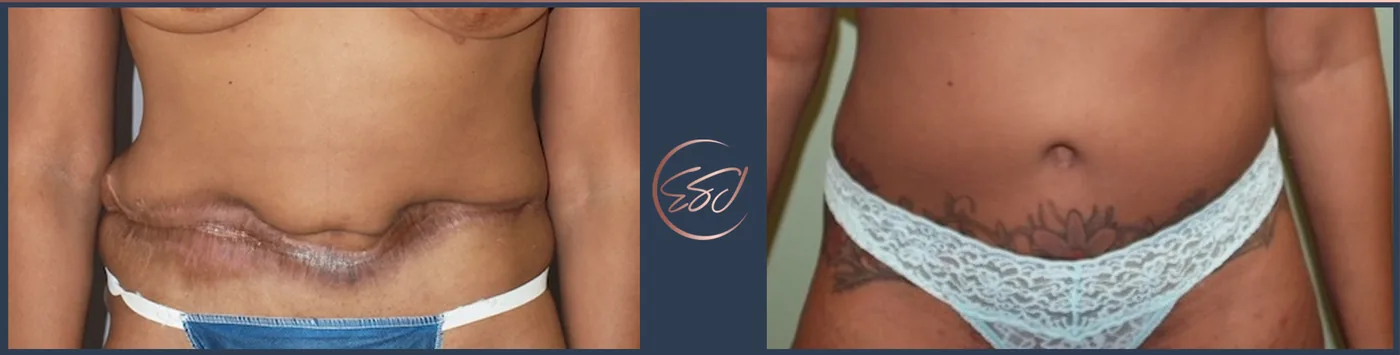 From Frustration to Fulfillment: Correcting Botched Cosmetic Surgeries