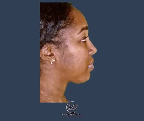 The same patient in profile after chin and neck contouring surgery, with a more defined chin and jawline