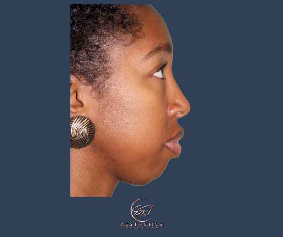 Side view of a patient's face before chin and neck contouring surgery, showing the chin and jawline in profile