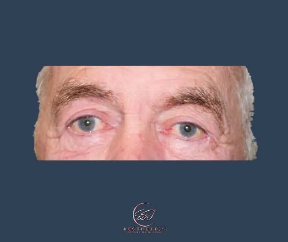 The same man's eyes after upper eyelid surgery, with the upper lid crease visible again