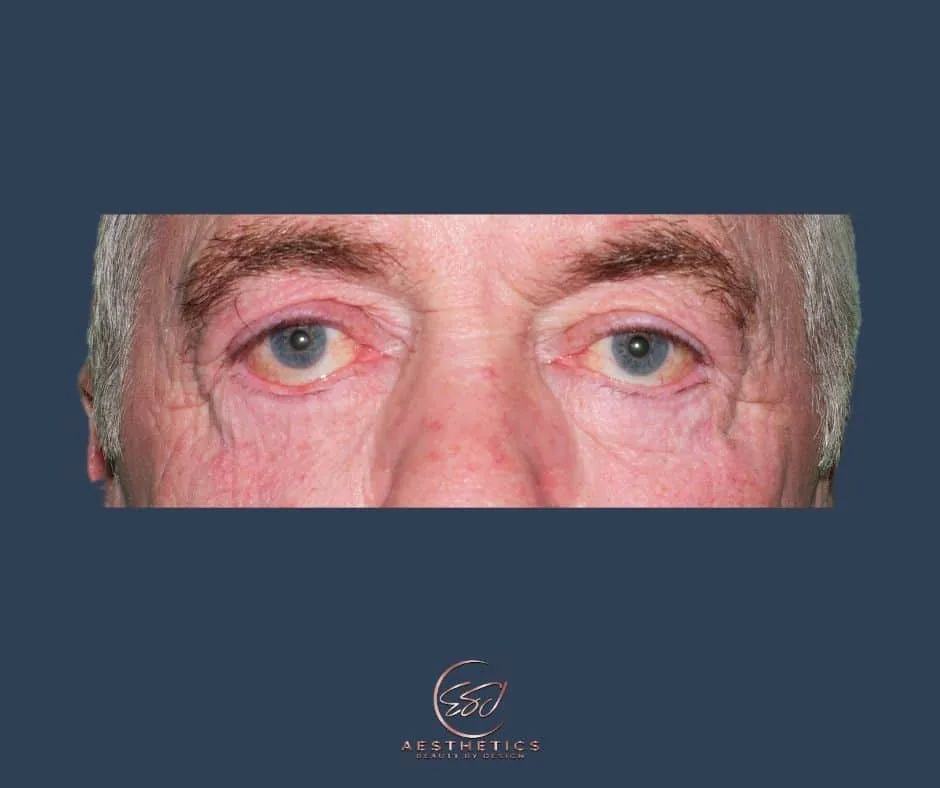 A man's eyes before upper eyelid surgery, with loose skin resting on the upper lids