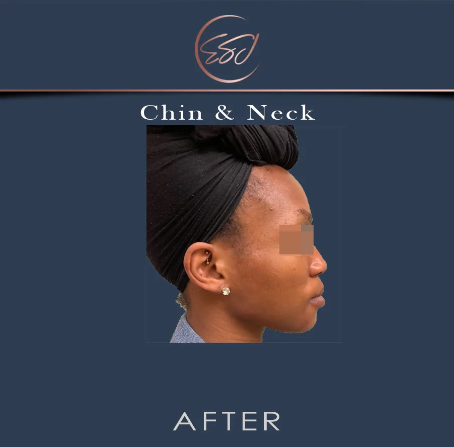 Chin and neck contouring patient, right profile, after surgery