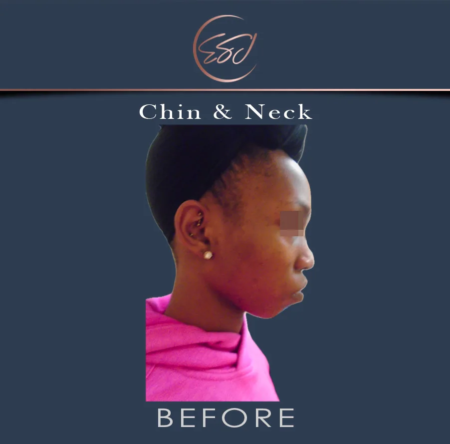 Chin and neck contouring patient, right profile, before surgery