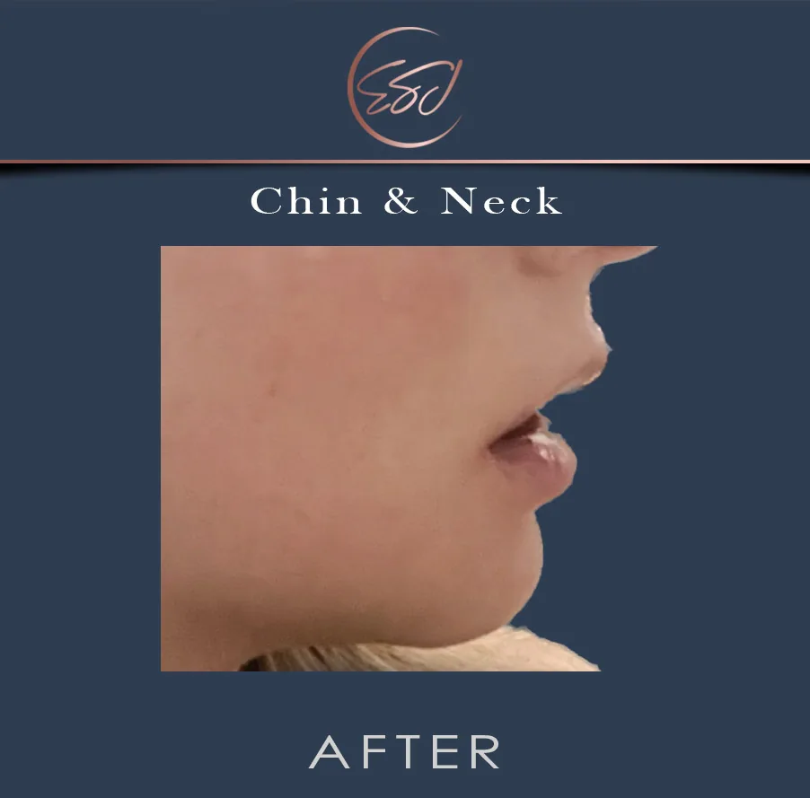 Chin and jawline contouring patient, close profile, after surgery