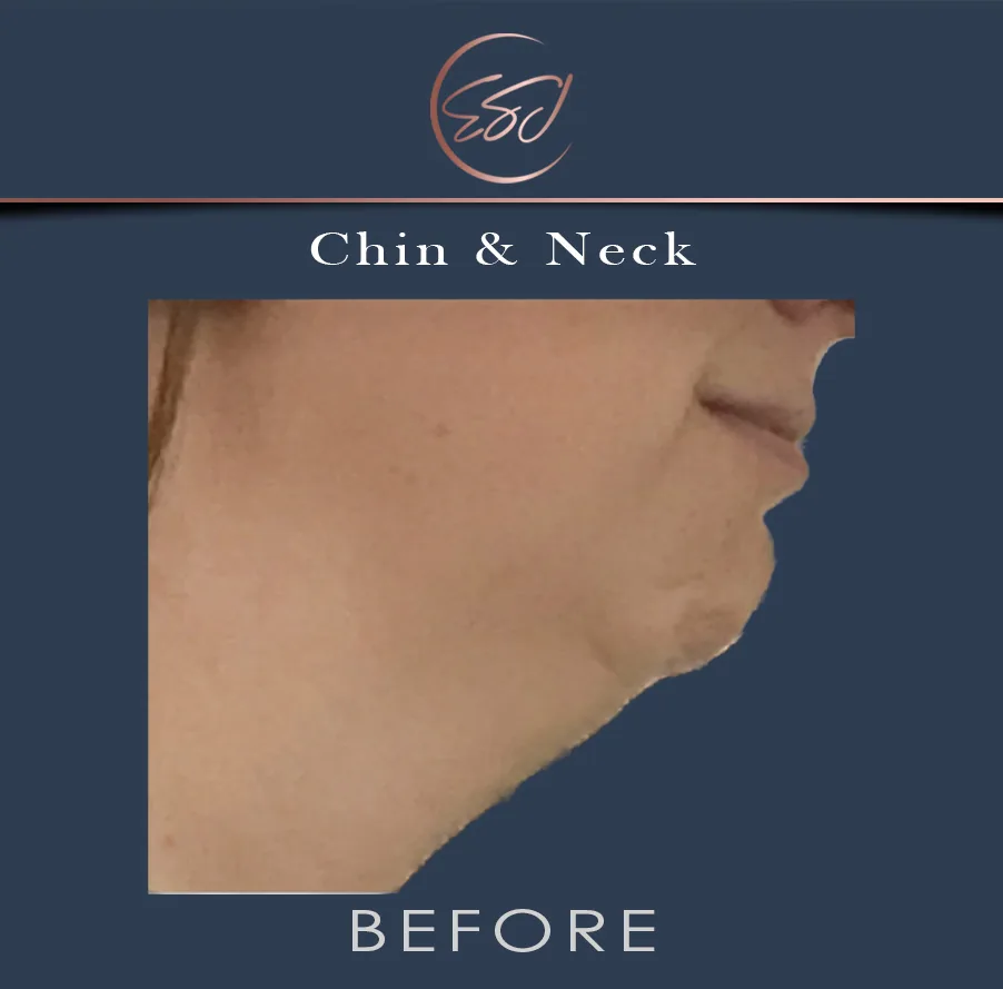 Chin and jawline contouring patient, close profile, before surgery