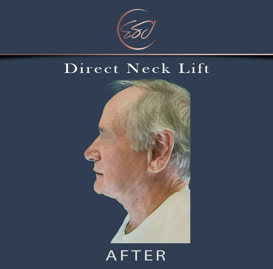 Direct neck lift patient, left profile, after surgery