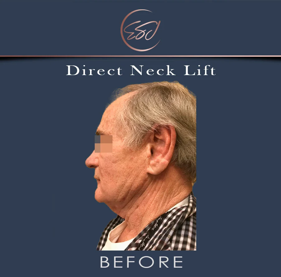 Direct neck lift patient, left profile, before surgery