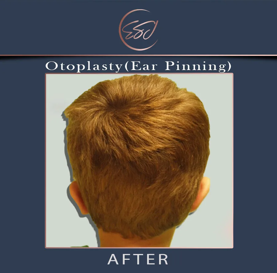Second otoplasty patient, rear view of both ears, after surgery