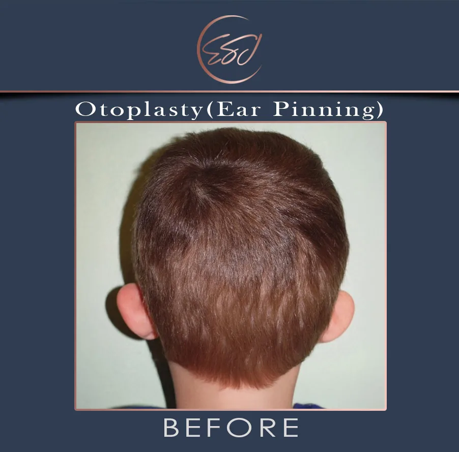 Second otoplasty patient, rear view of both ears, before surgery
