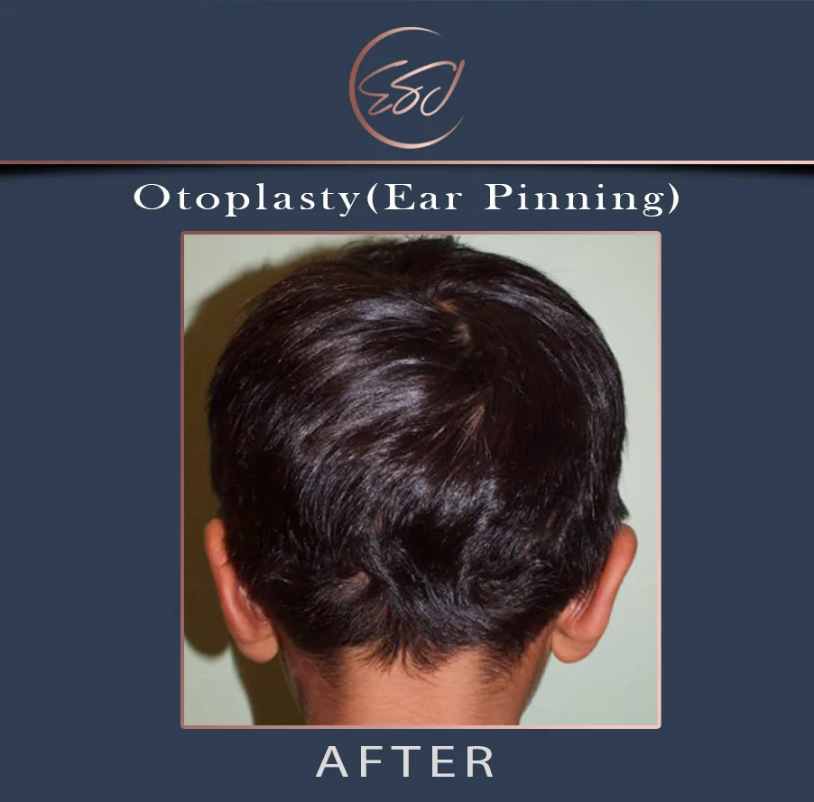 Otoplasty patient, rear view of both ears, after surgery