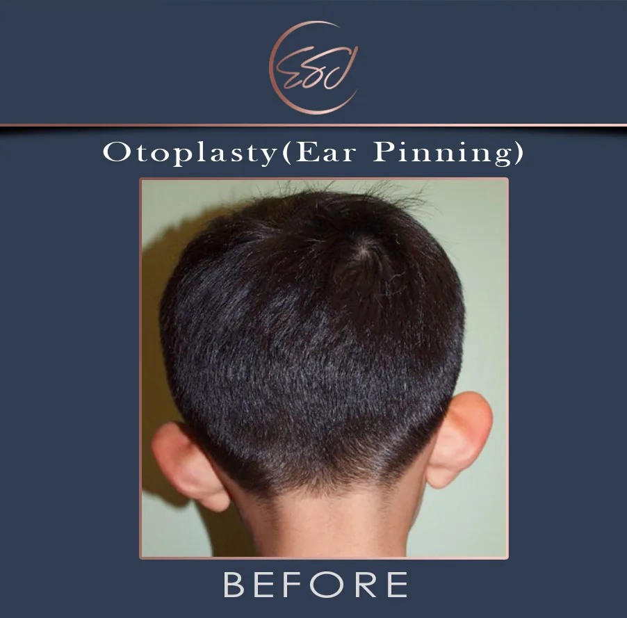 Otoplasty patient, rear view of both ears, before surgery