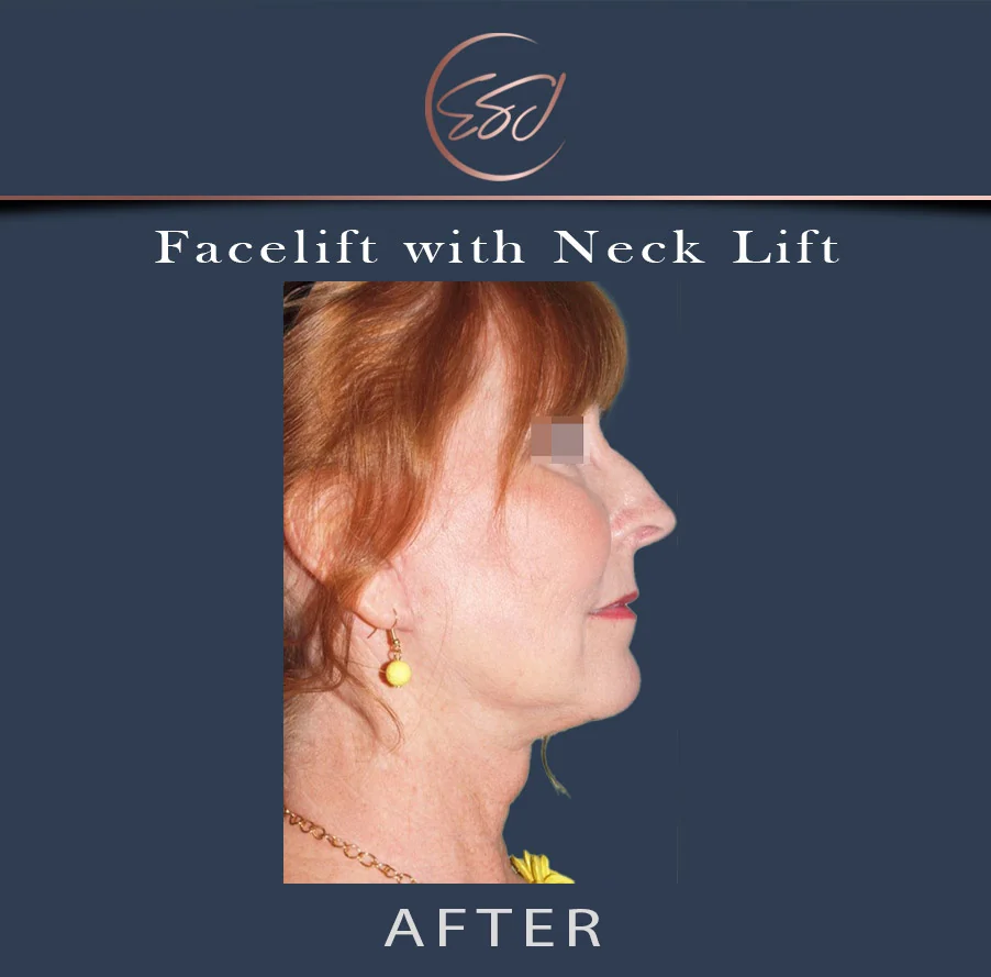 Facelift with neck lift patient, right profile, after surgery