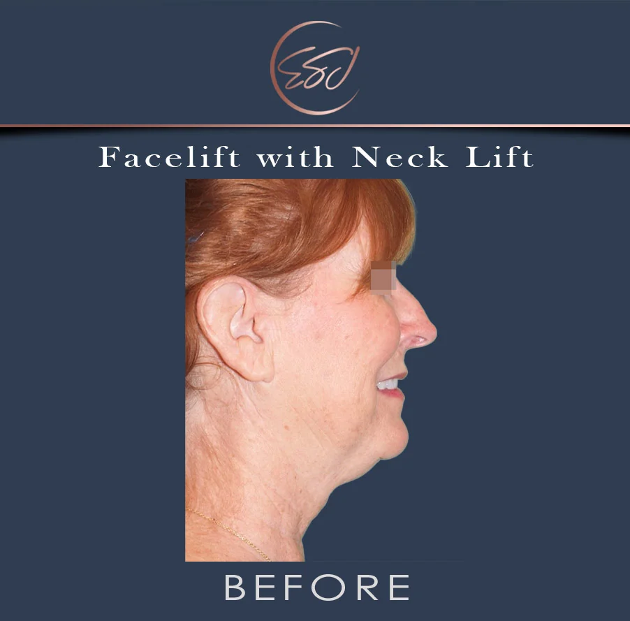 Facelift with neck lift patient, right profile, before surgery