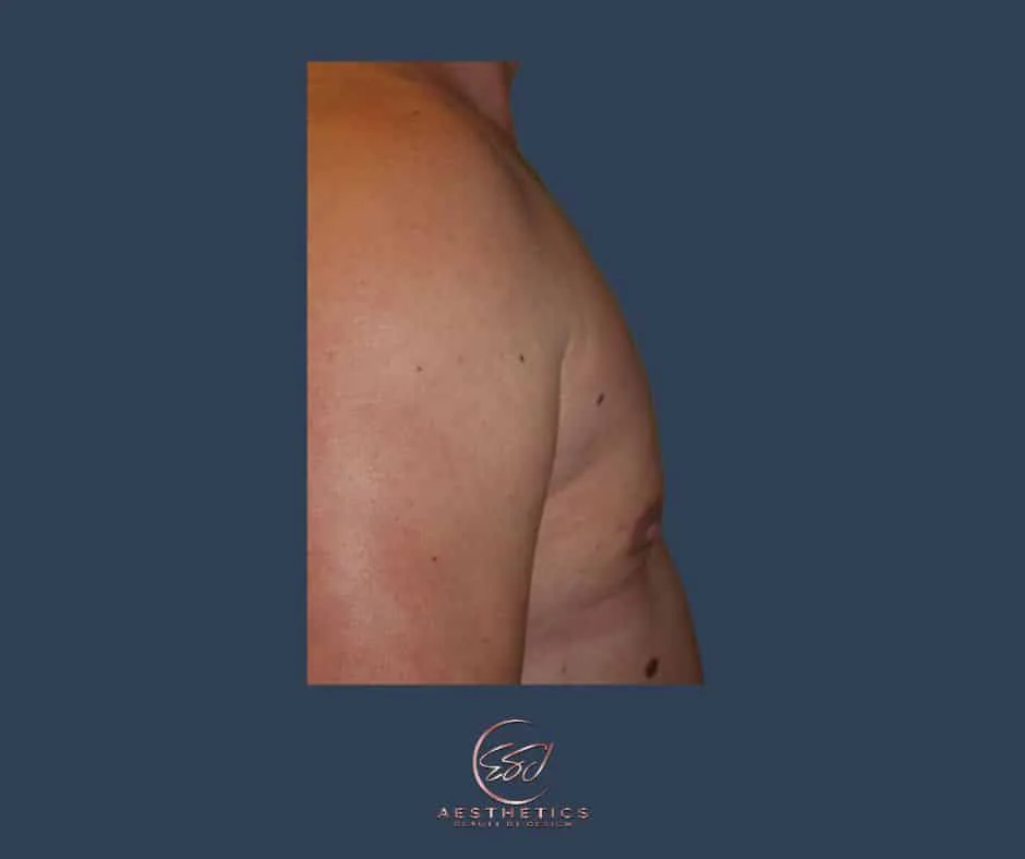 Second gynecomastia patient, chest in profile, after surgery