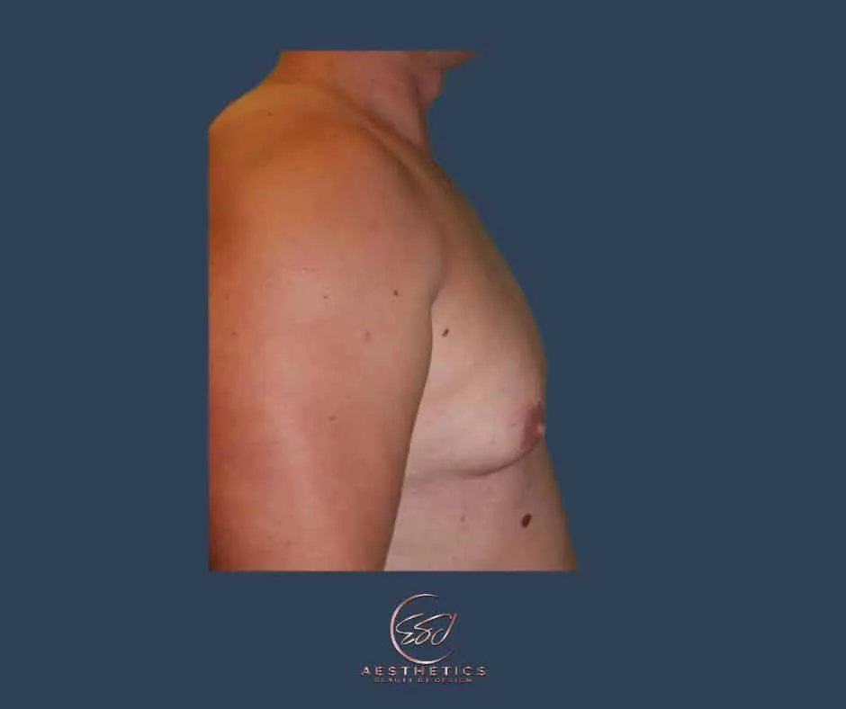 Second gynecomastia patient, chest in profile, before surgery