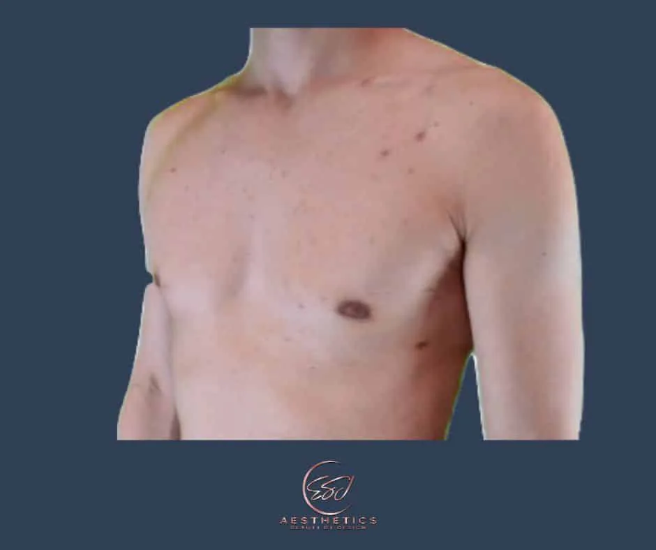 Gynecomastia patient, chest at three-quarter view, after surgery