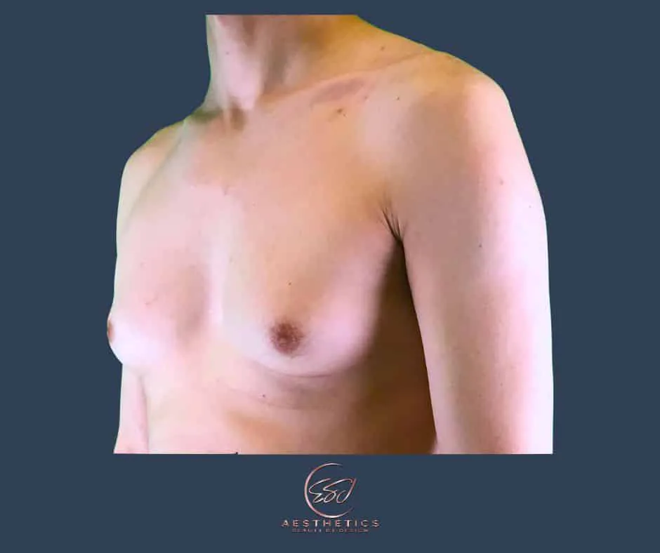 Gynecomastia patient, chest at three-quarter view, before surgery