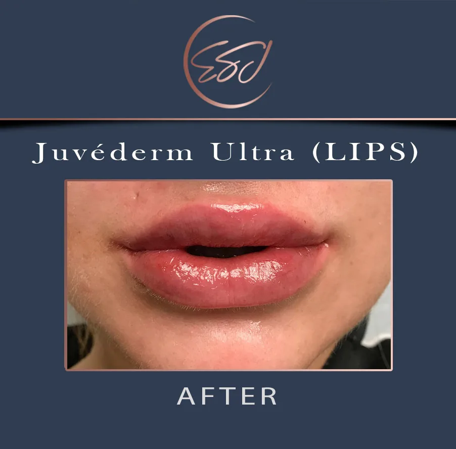 Lip filler patient, lower face, after treatment