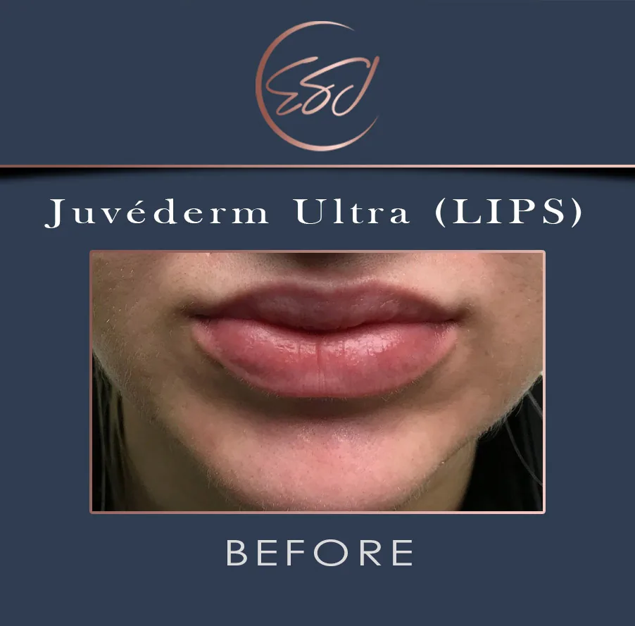 Lip filler patient, lower face, before treatment