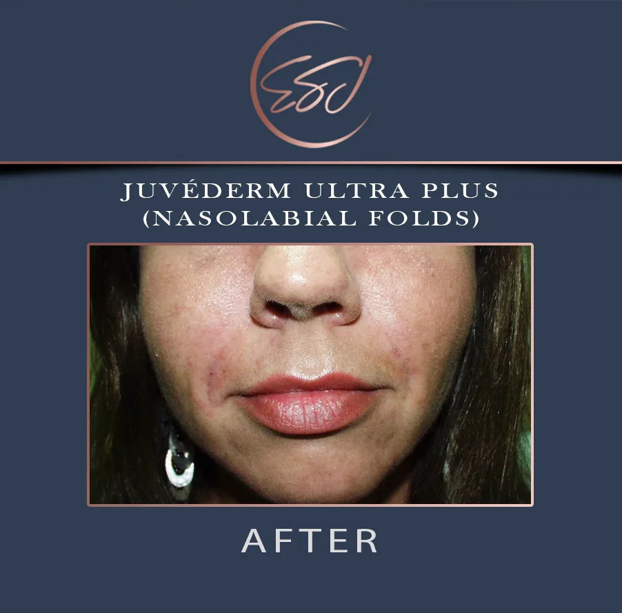 Nasolabial fold filler patient, lower face, after treatment