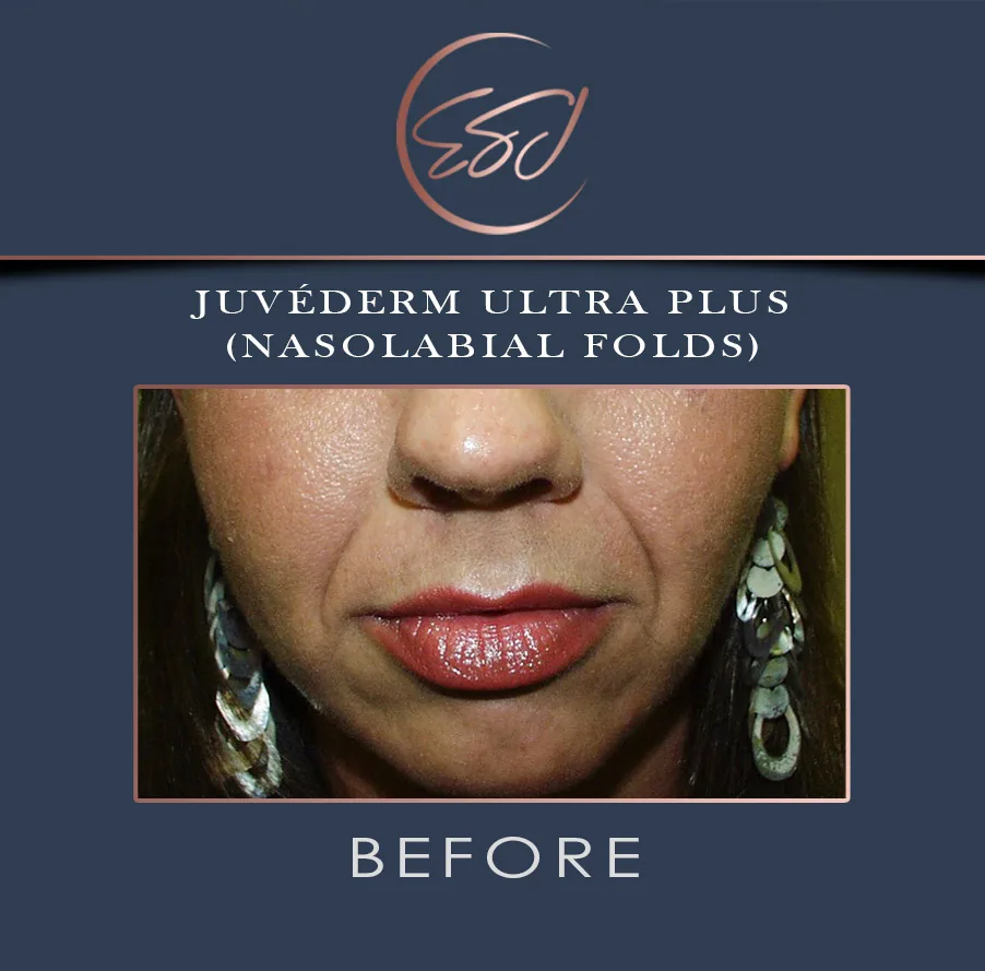 Nasolabial fold filler patient, lower face, before treatment