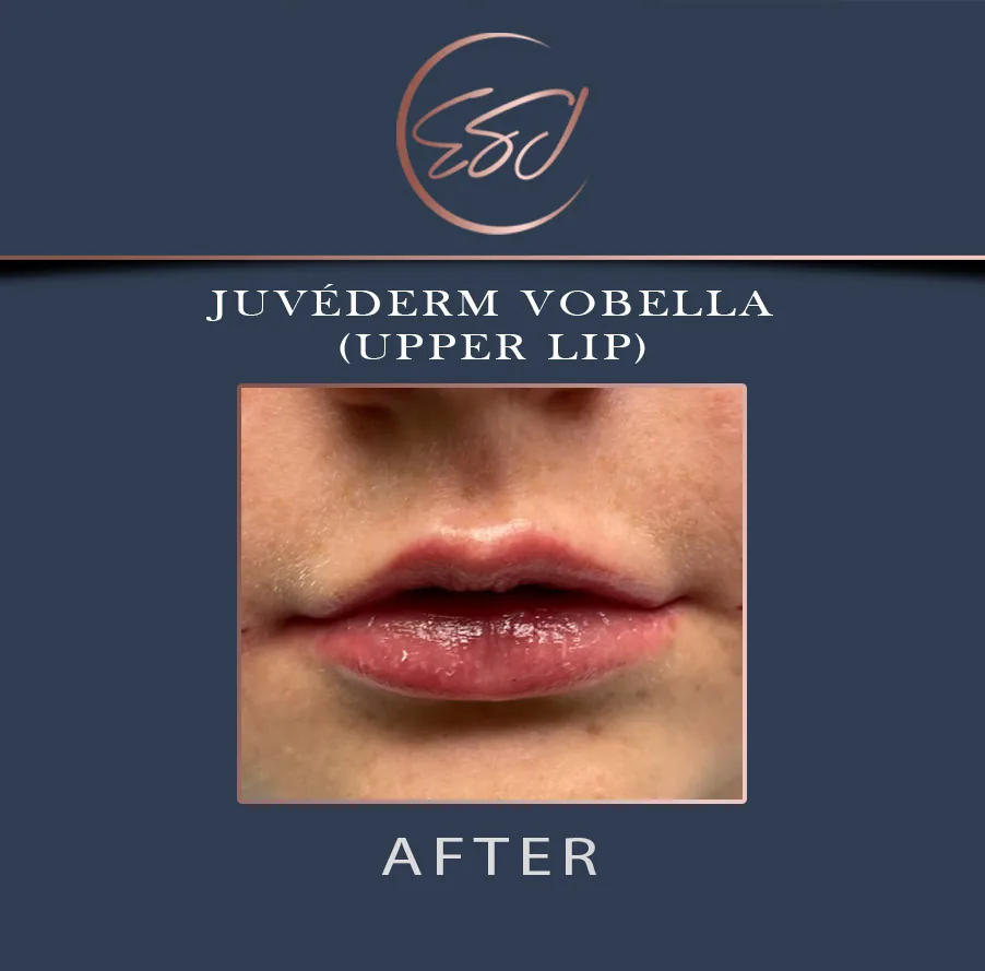 Upper lip filler patient, lower face, after treatment