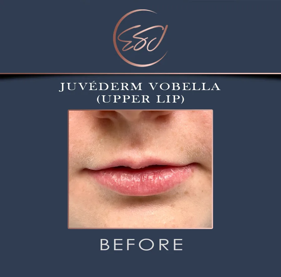 Upper lip filler patient, lower face, before treatment