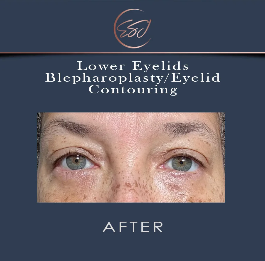 Lower eyelid blepharoplasty patient, both eyes, after surgery