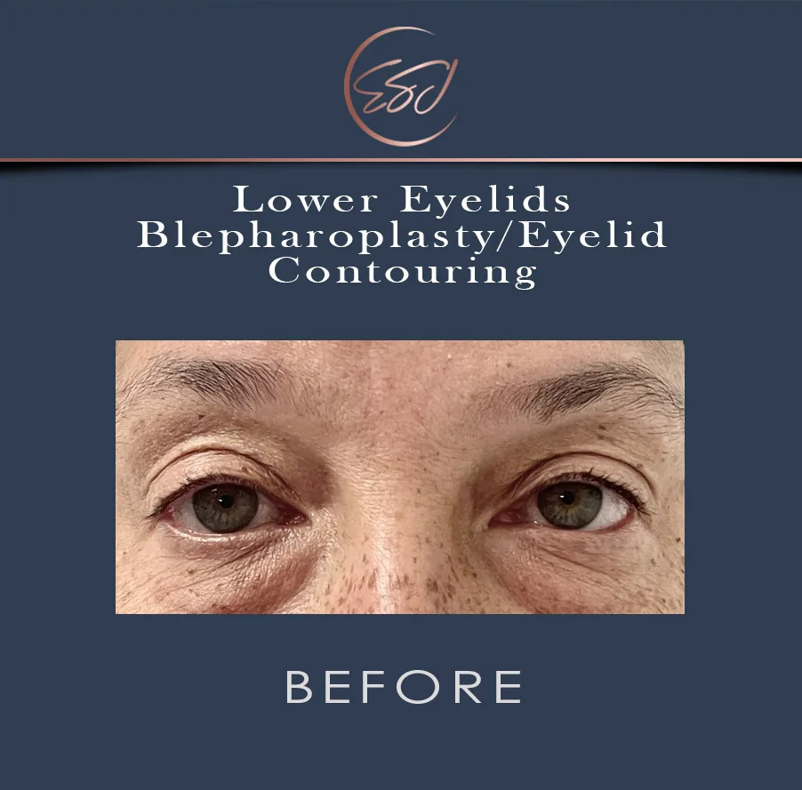 Lower eyelid blepharoplasty patient, both eyes, before surgery