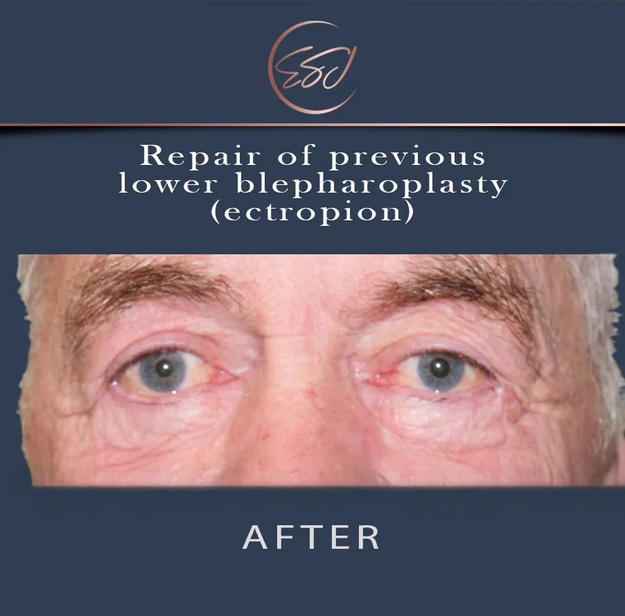 Repair of a previous lower blepharoplasty, both eyes, after surgery