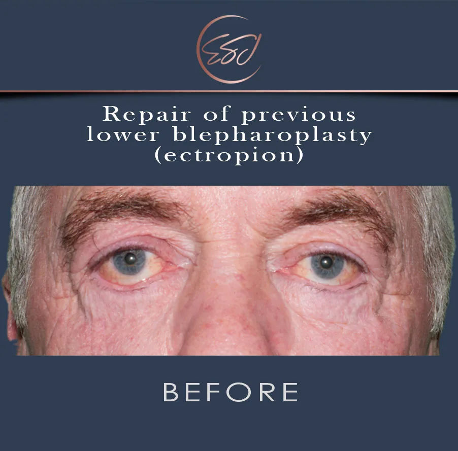 Repair of a previous lower blepharoplasty, both eyes, before surgery