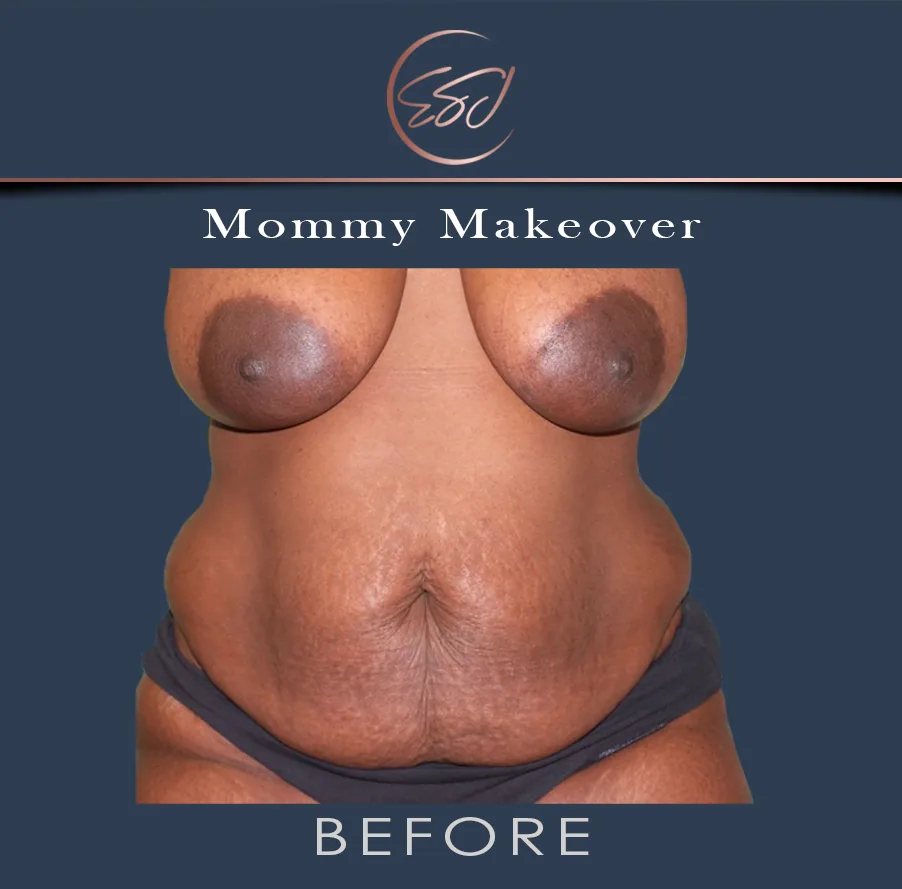 Mommy makeover patient, torso from the front, before surgery