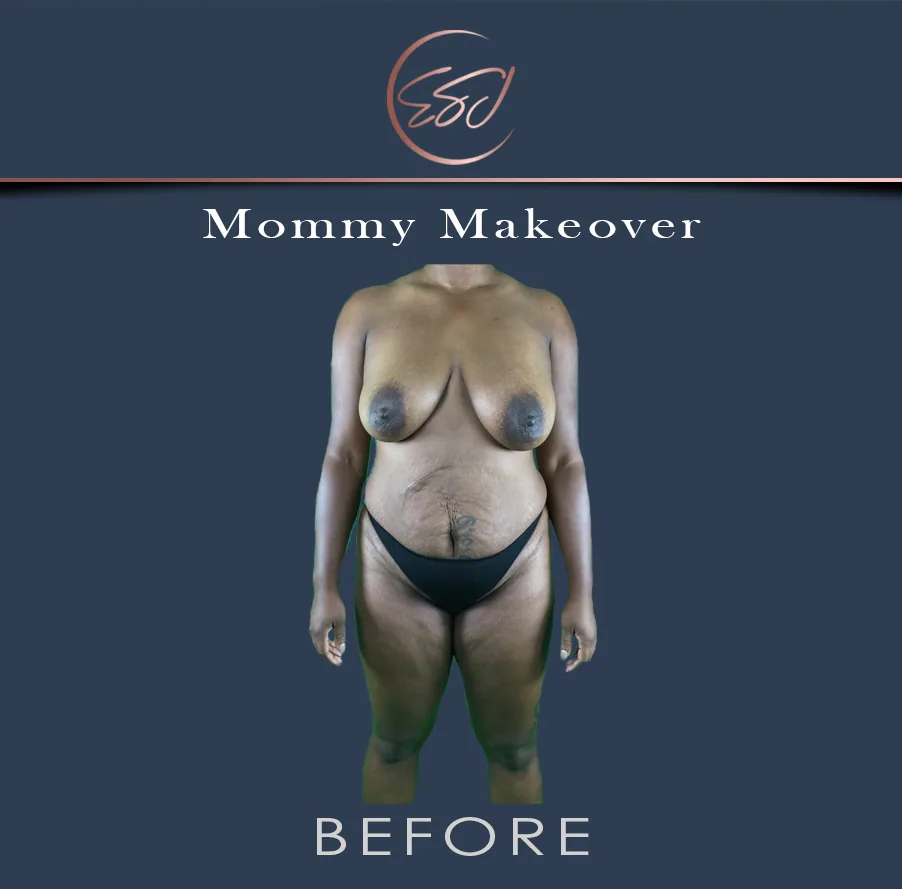 Mommy makeover patient, full torso from the front, before surgery