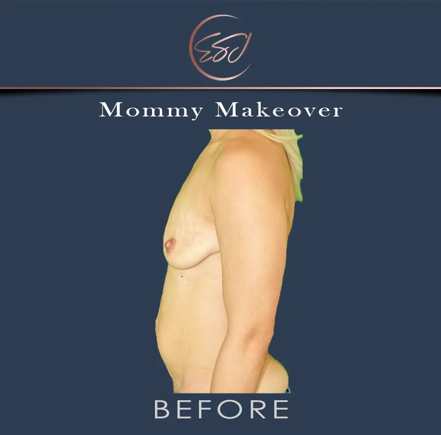 Mommy makeover patient, torso in profile, before surgery