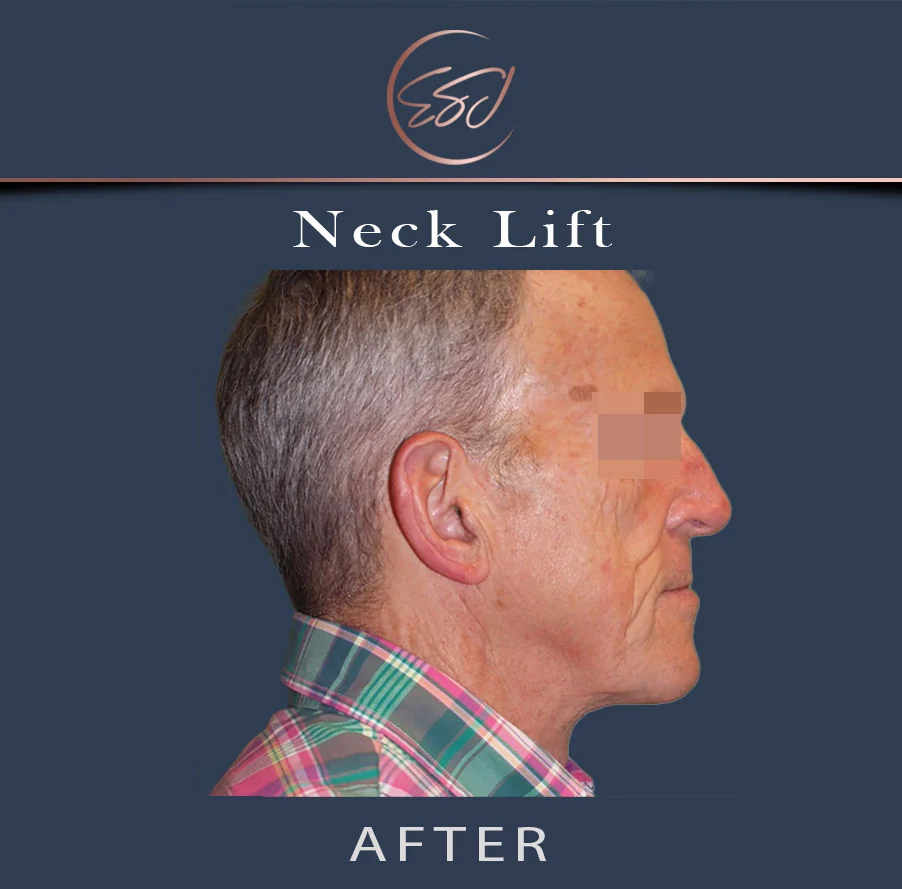 Neck lift patient, right profile, after surgery