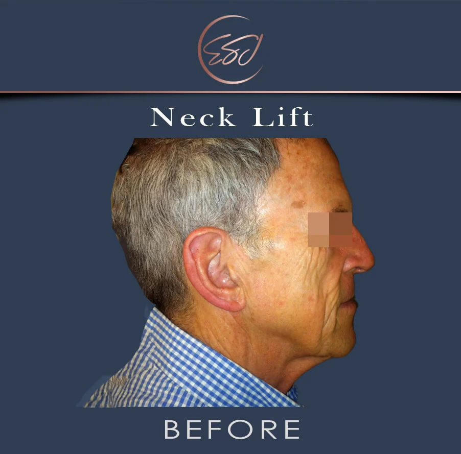 Neck lift patient, right profile, before surgery
