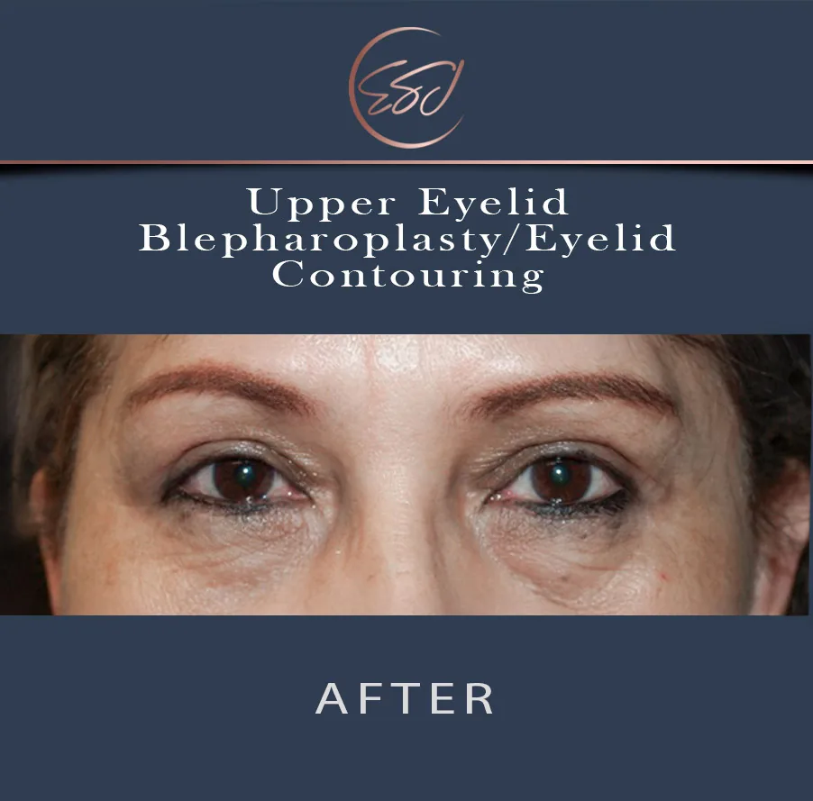 Upper eyelid blepharoplasty patient, both eyes, after surgery