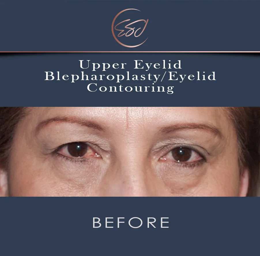 Upper eyelid blepharoplasty patient, both eyes, before surgery